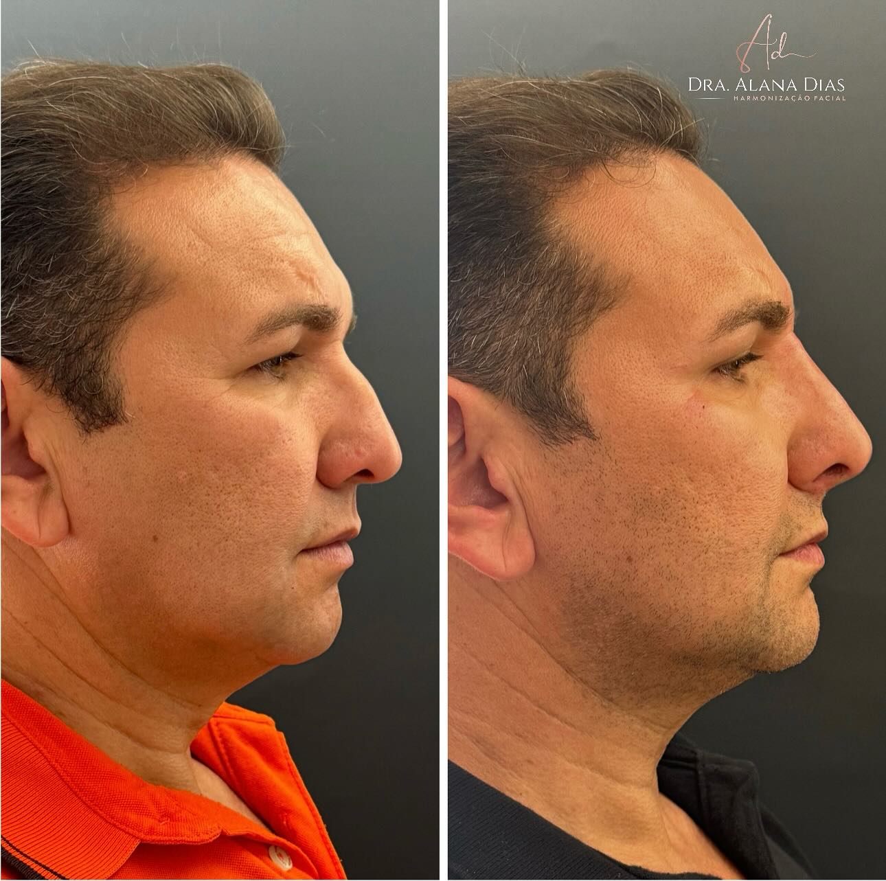 Resultado de Harmonização Masculina