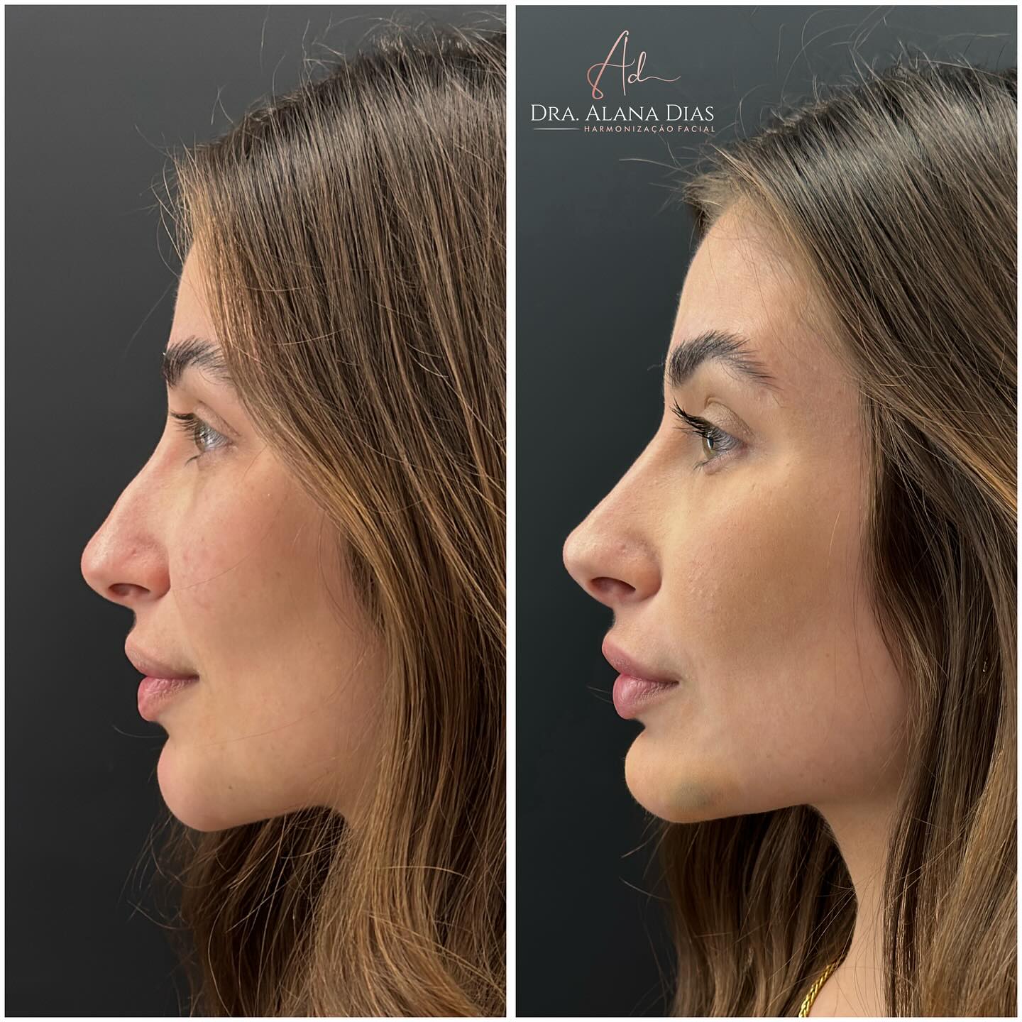 Resultado de Harmonização Feminina